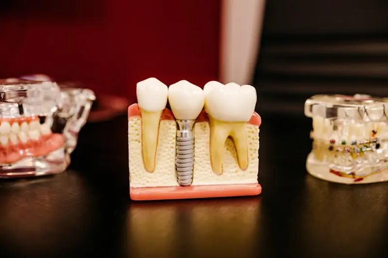 Modelo de dente com implante dentário instalado